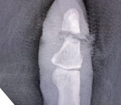 Несколько жительниц Ярославля попали в больницу с отрезанными электросекаторами пальцами